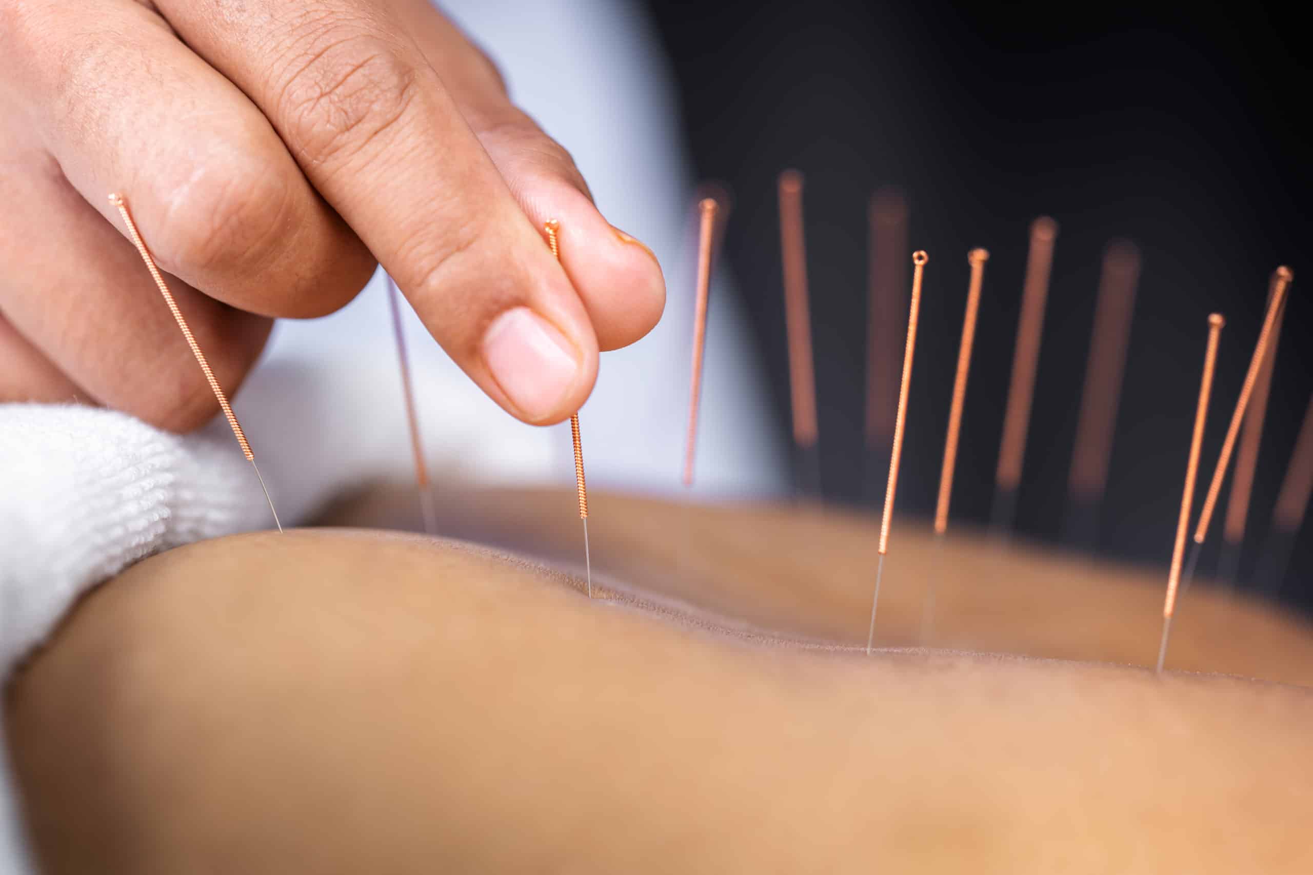 Langley Acupuncture