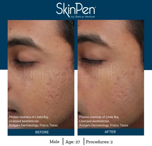 Facial Microneedling Langley before and after 2 e1673475524202
